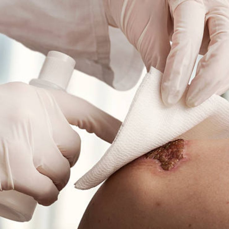 Dermatological Dressing - Advanced Wound Care Dressing