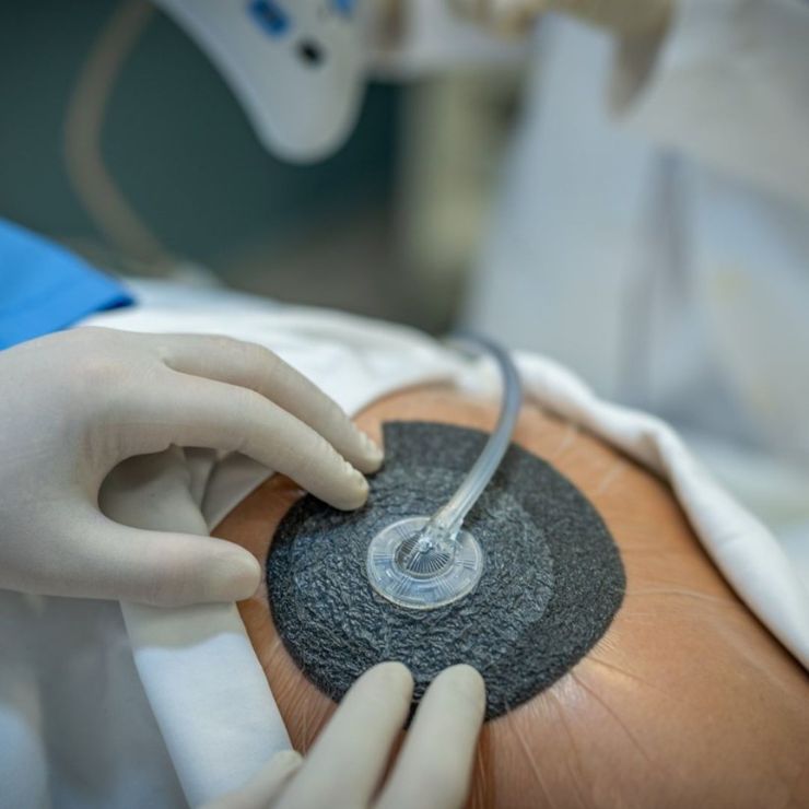 NPWT Dressing (Negative Pressure Wound Therapy) - Advanced Wound Care Dressing